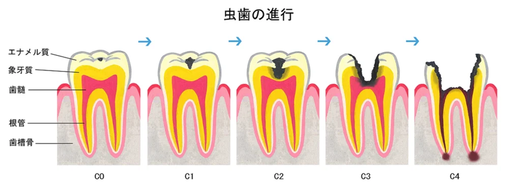 虫歯の進行について