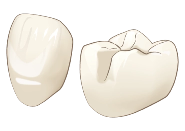 歯の被せ物材質イラスト